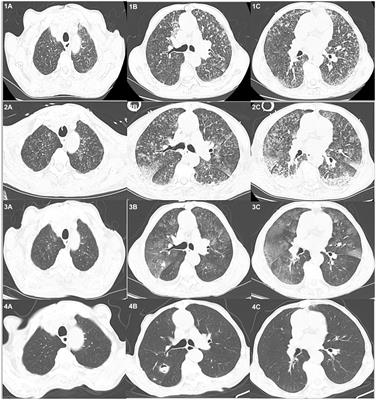 Diagnosis of pulmonary hemorrhagic leptospirosis complicated by invasive pulmonary aspergillosis complemented by metagenomic next-generation sequencing: a case report